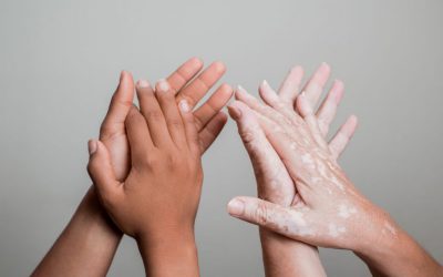 Vitiligo, problema estetica sau boala? Afla raspunsul!